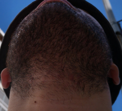 beard+hair-transplant