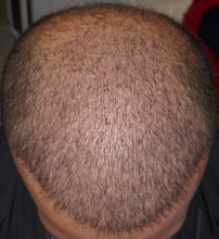 beard+hair-transplant