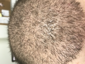estemylife-4275-grafts