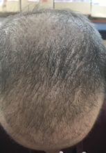 estemylife-4275-grafts