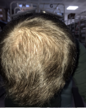 estemylife-4275-grafts