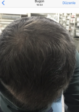 estemylife-4275-grafts