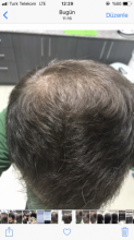 estemylife-4275-grafts