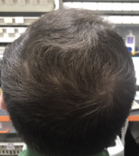 estemylife-4275-grafts