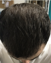 estemylife-4275-grafts