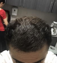 estemylife-4275-grafts