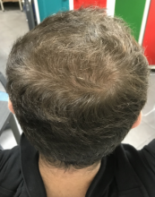 estemylife-4275-grafts