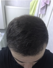 estemylife-4275-grafts