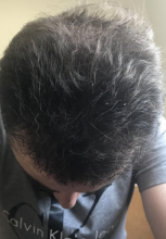 estemylife-4275-grafts