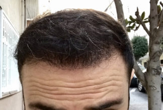 estemylife-4275-grafts