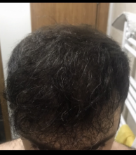 estemylife-4275-grafts