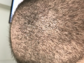 estemylife-4275-grafts