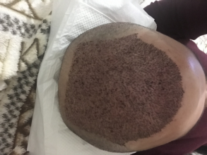 estemylife-4275-grafts