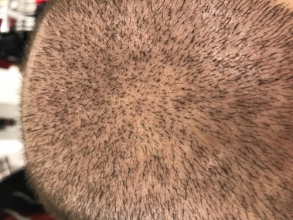 estemylife-4275-grafts