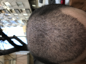 estemylife-4275-grafts