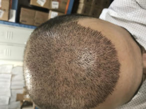 estemylife-4275-grafts