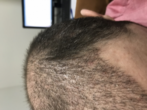 estemylife-4275-grafts