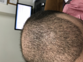 estemylife-4275-grafts