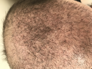 estemylife-4275-grafts