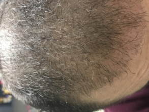 estemylife-4275-grafts
