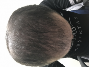 estemylife-4275-grafts
