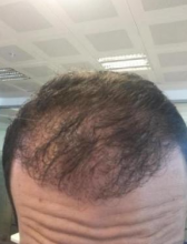 estemylife-hair-transplant
