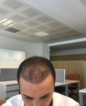 estemylife-hair-transplant