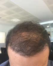 estemylife-hair-transplant