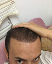 estemylife-hair-transplant