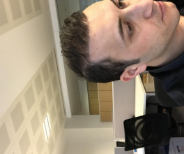 estemylife-hair-transplant