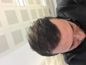 estemylife-hair-transplant