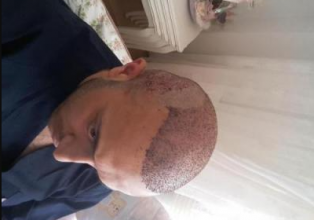 estemylife-hair-transplant