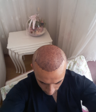estemylife-hair-transplant
