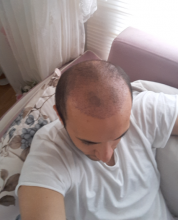 estemylife-hair-transplant