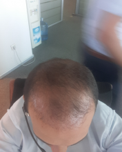 estemylife-hair-transplant