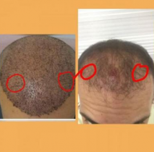estemylife-hair-transplant