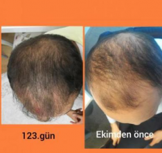 estemylife-hair-transplant
