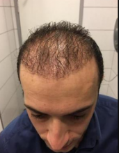estemylife-hair-transplant