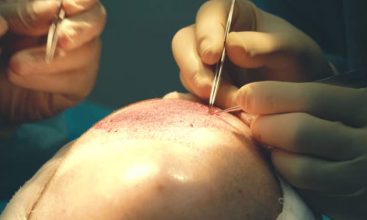 hair-transplant-prices-2020