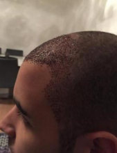 izmir-turkey-hair-transplant