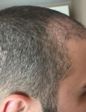 izmir-turkey-hair-transplant