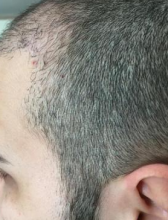 izmir-turkey-hair-transplant