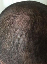 izmir-turkey-hair-transplant