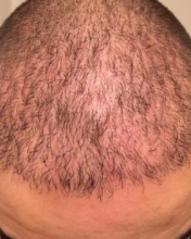 izmir-turkey-hair-transplant