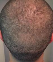 izmir-turkey-hair-transplant
