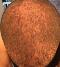 izmir-turkey-hair-transplant