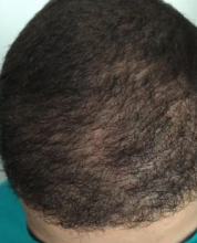 izmir-turkey-hair-transplant