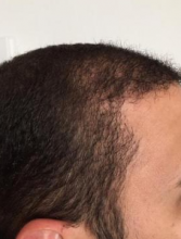 izmir-turkey-hair-transplant