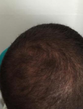 izmir-turkey-hair-transplant
