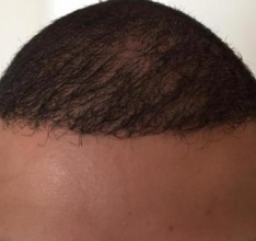 izmir-turkey-hair-transplant